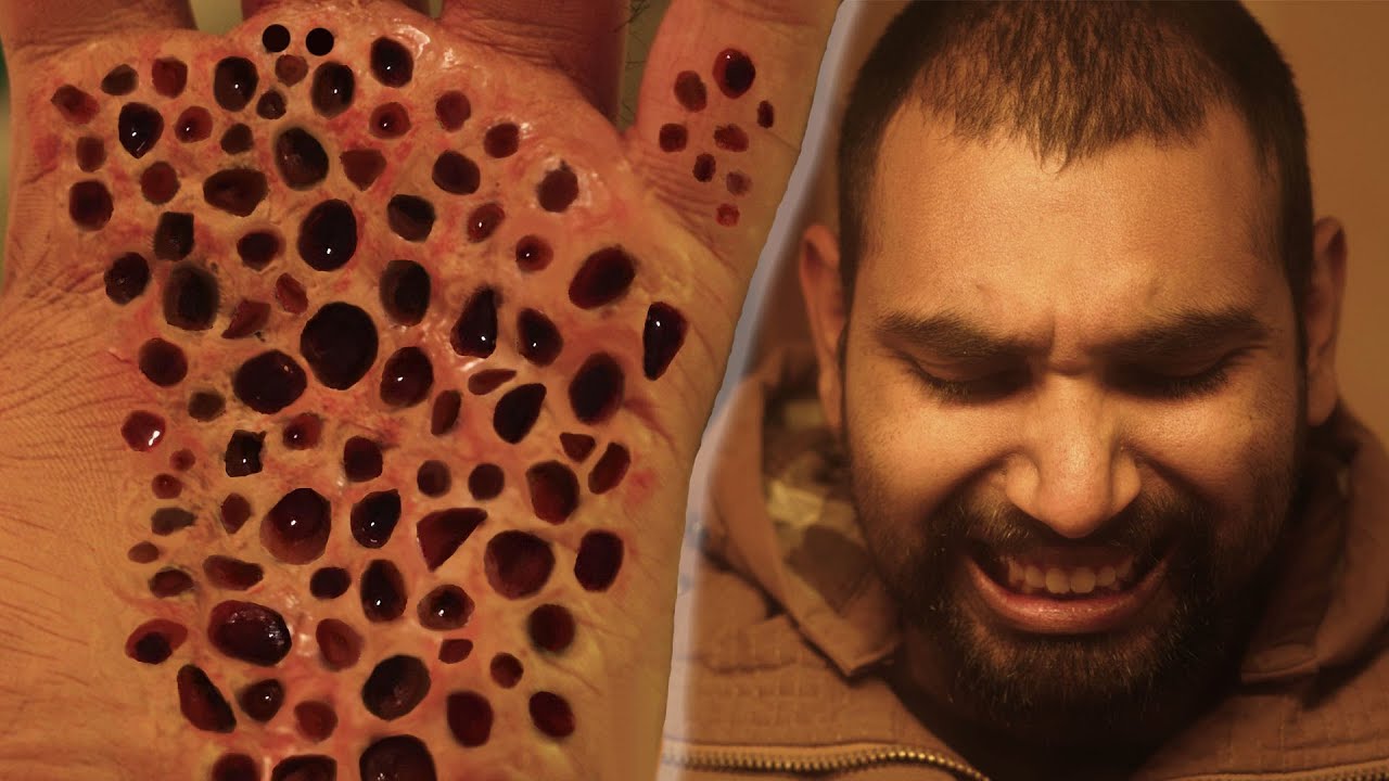 What Are the Symptoms of Trypophobia?