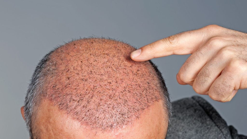 Why FUE hair transplants are the most popular