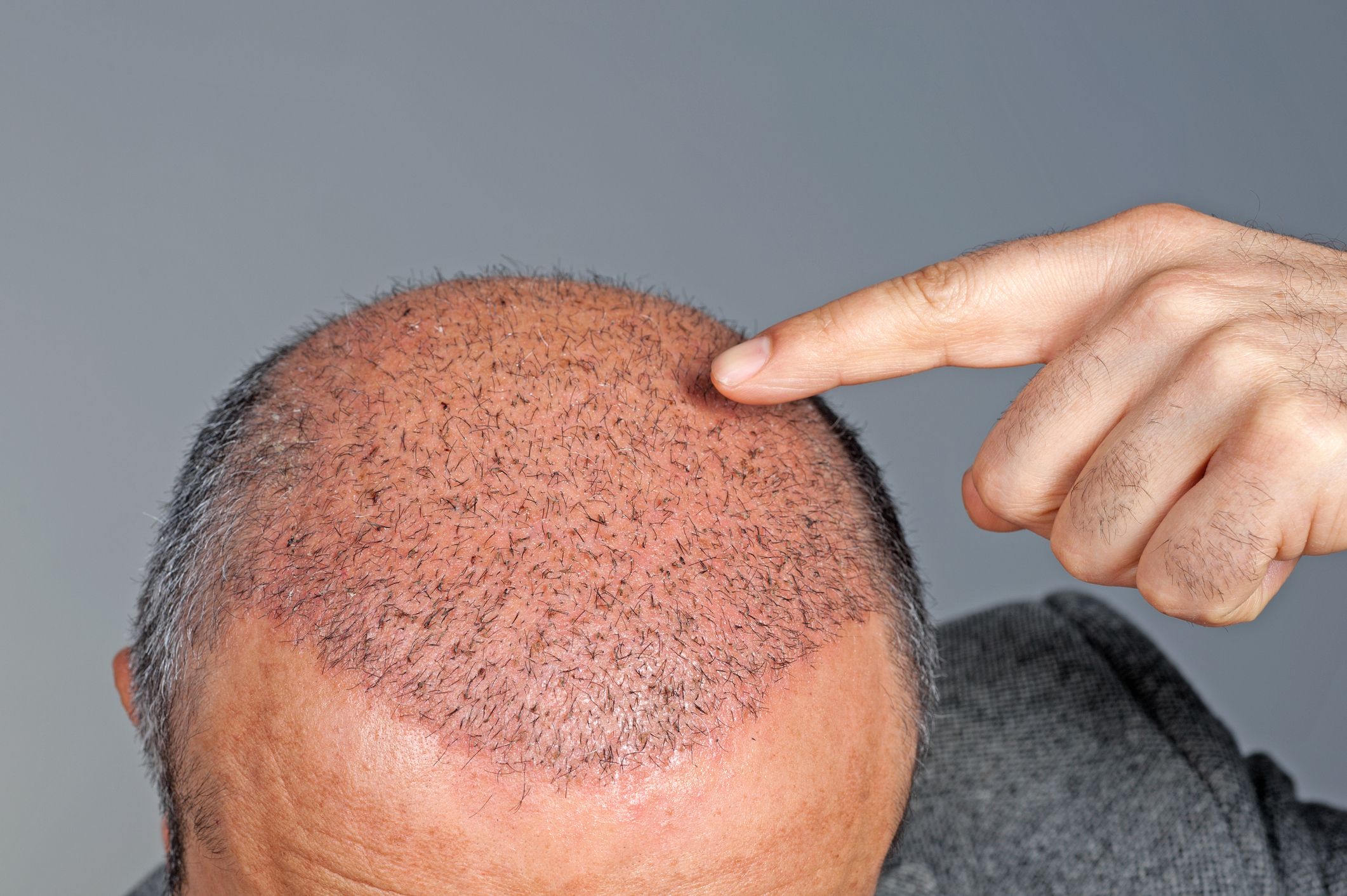 Why FUE hair transplants are the most popular