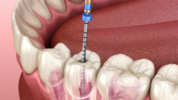 ROOT CANAL TREATMENT: A COMPREHENSIVE GUIDE
