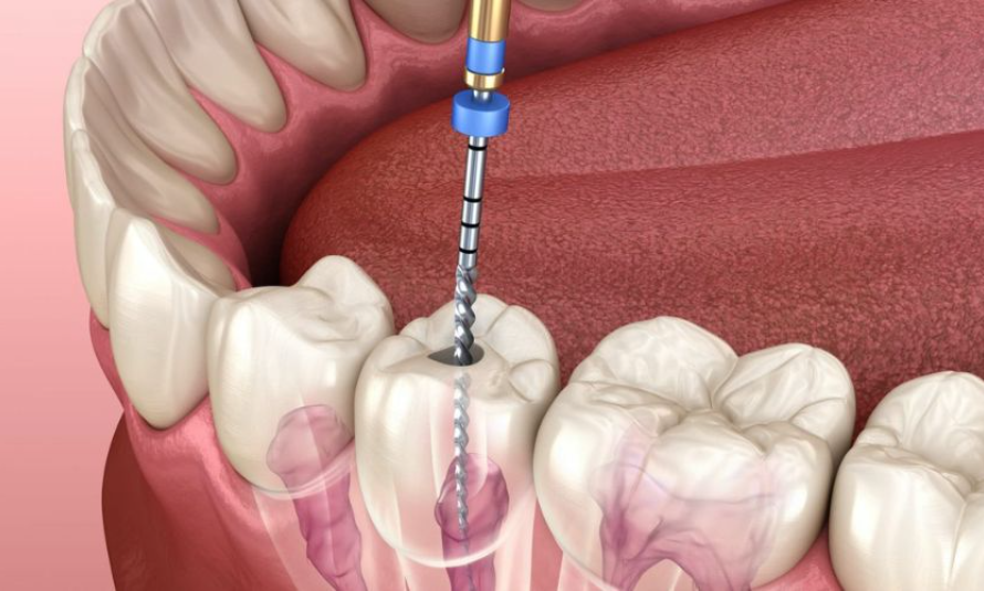 ROOT CANAL TREATMENT: A COMPREHENSIVE GUIDE